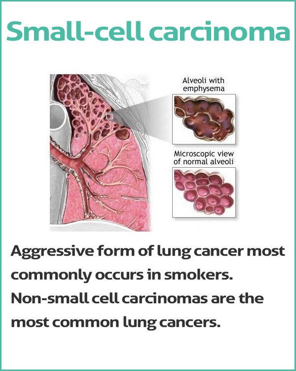 small cell lung cancer